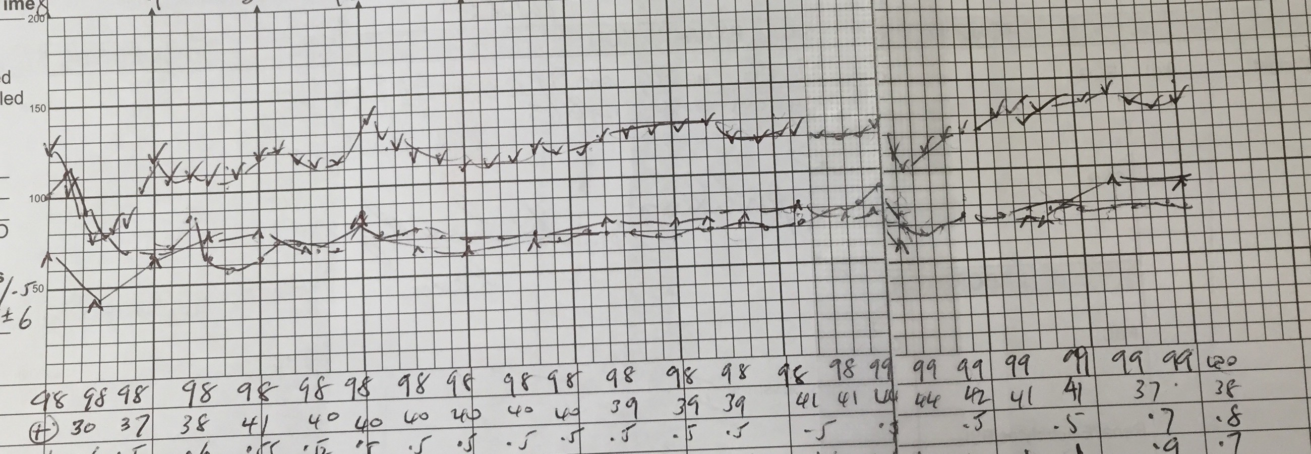 Cropped anesthetic record showing blood pressure changing repeatedly during a long surgery.